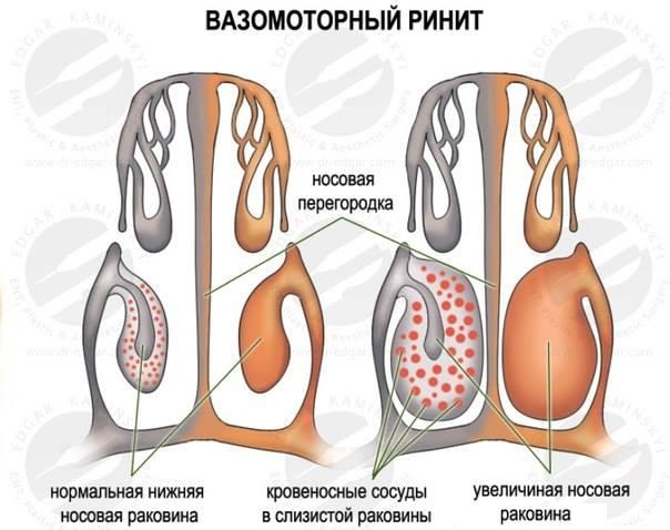 Почему возникает вазомоторный ринит и можно ли его вылечить?